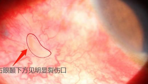 男子未帶防護(hù)眼鏡致異物入眼