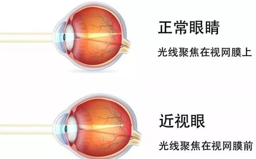 戴眼鏡是否真的會加深近視