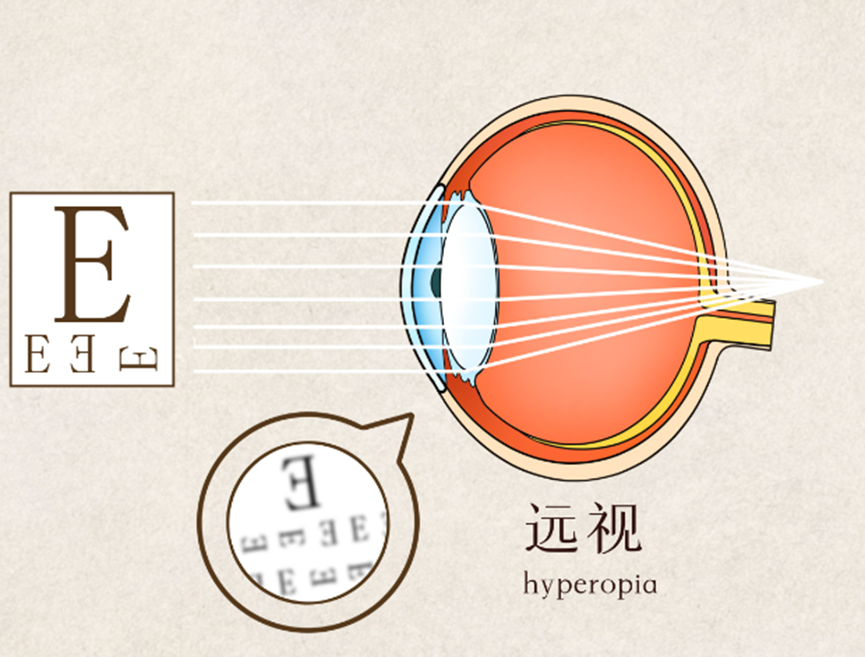 遠(yuǎn)視