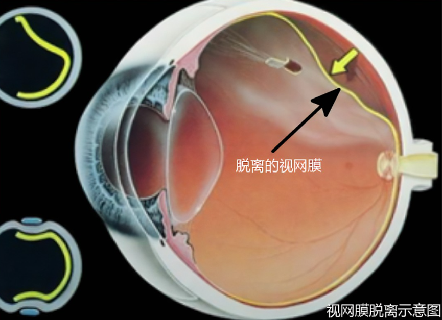 視網(wǎng)膜脫落